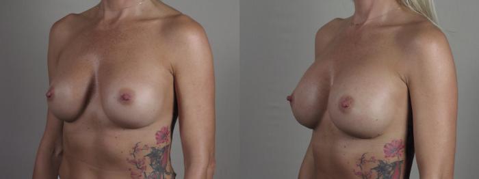 Breast Implant Revision Case 1406 Before & After Side view | Paramus, New Jersey | Parker Center for Plastic Surgery