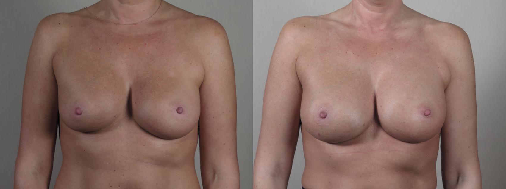 Breast Implant Revision Case 1413 Before & After Front | Paramus, New Jersey | Parker Center for Plastic Surgery