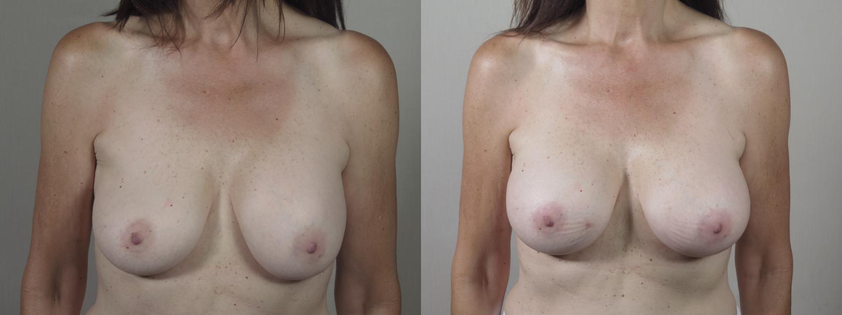 Breast Implant Revision Case 1422 Before & After Front | Paramus, New Jersey | Parker Center for Plastic Surgery