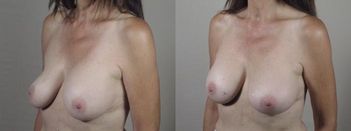 Breast Implant Revision Case 1422 Before & After Side view | Paramus, New Jersey | Parker Center for Plastic Surgery