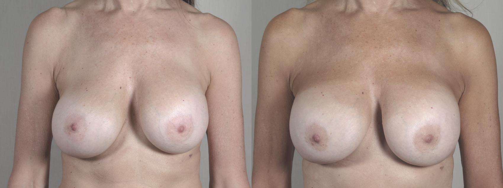 Breast Implant Revision Case 1461 Before & After Front | Paramus, New Jersey | Parker Center for Plastic Surgery