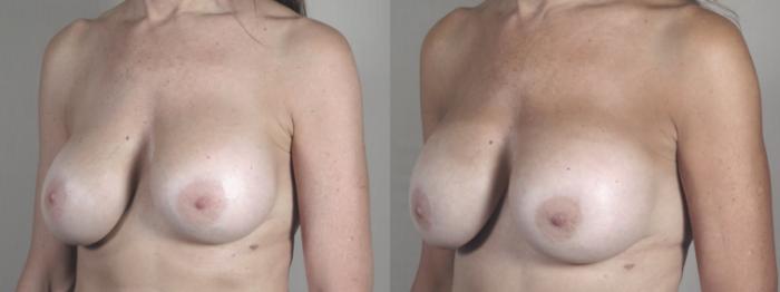 Breast Implant Revision Case 1461 Before & After Left Oblique | Paramus, New Jersey | Parker Center for Plastic Surgery