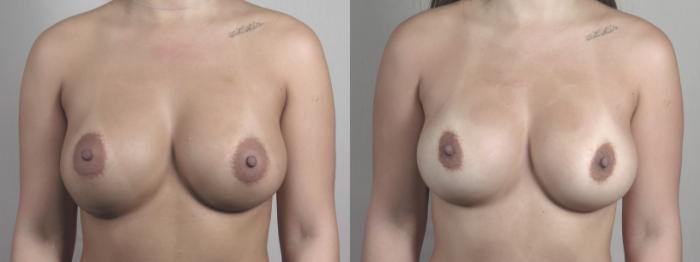 Breast Implant Revision Case 1462 Before & After Front | Paramus, New Jersey | Parker Center for Plastic Surgery