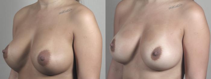 Breast Implant Revision Case 1462 Before & After Left Oblique | Paramus, New Jersey | Parker Center for Plastic Surgery