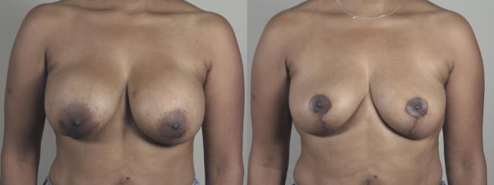 Breast Implant Revision Case 1464 Before & After Front | Paramus, New Jersey | Parker Center for Plastic Surgery