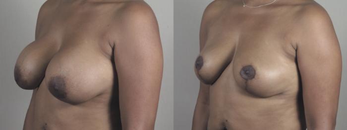 Breast Implant Revision Case 1464 Before & After Left Oblique | Paramus, New Jersey | Parker Center for Plastic Surgery