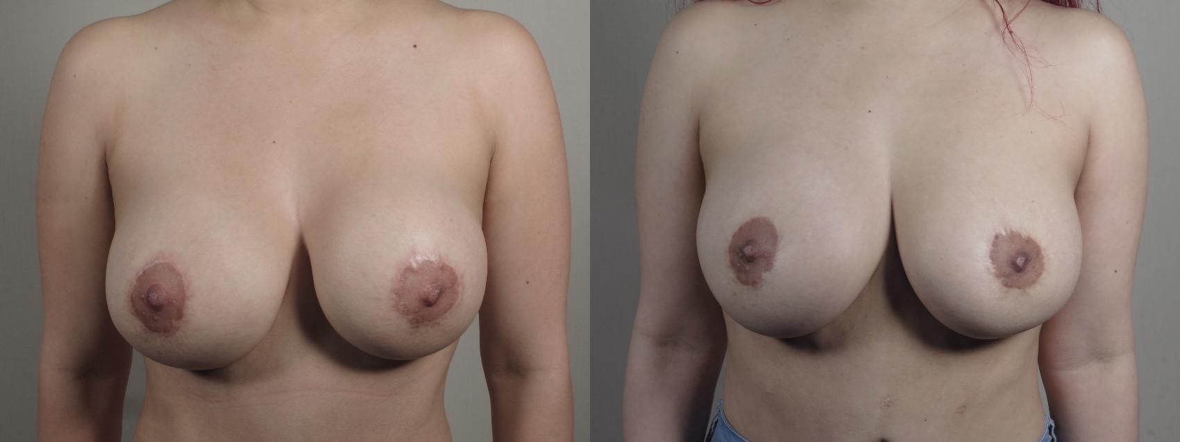 Breast Implant Revision Case 1504 Before & After Front | Paramus, New Jersey | Parker Center for Plastic Surgery