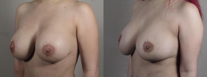 Breast Implant Revision Case 1504 Before & After Left Oblique | Paramus, New Jersey | Parker Center for Plastic Surgery