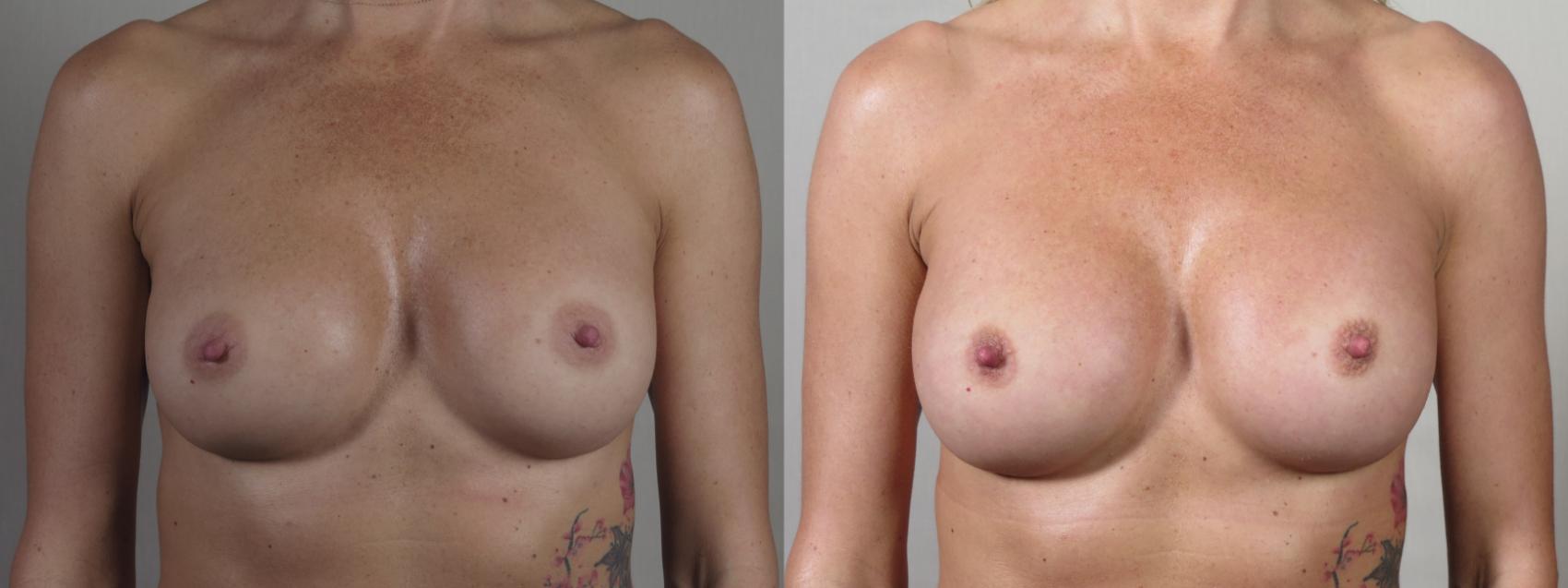 Breast Implant Revision Case 1542 Before & After Front | Paramus, New Jersey | Parker Center for Plastic Surgery