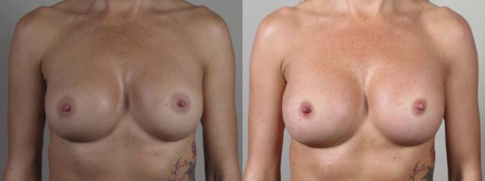 Breast Implant Revision Case 1542 Before & After Front | Paramus, New Jersey | Parker Center for Plastic Surgery