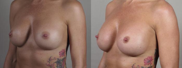 Breast Implant Revision Case 1542 Before & After Left Oblique | Paramus, New Jersey | Parker Center for Plastic Surgery