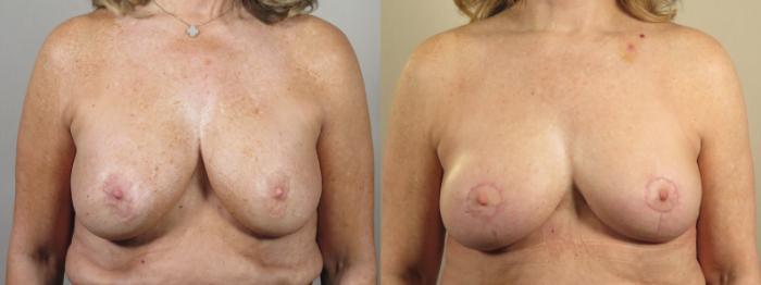 Breast Implant Revision Case 1550 Before & After Front | Paramus, New Jersey | Parker Center for Plastic Surgery