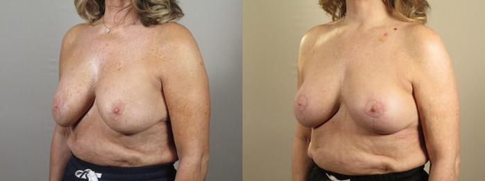 Breast Implant Revision Case 1550 Before & After Left Oblique | Paramus, New Jersey | Parker Center for Plastic Surgery