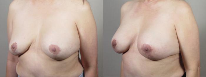 Breast Implant Revision Case 1567 Before & After Left Oblique | Paramus, New Jersey | Parker Center for Plastic Surgery