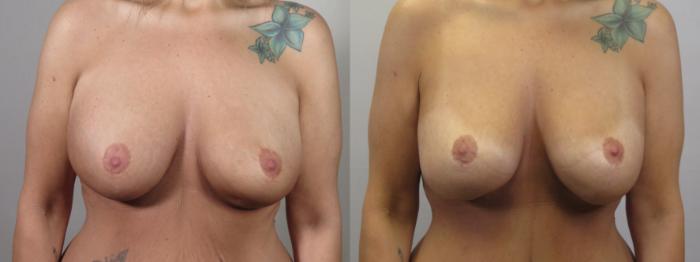 Breast Implant Revision Case 1589 Before & After Front | Paramus, New Jersey | Parker Center for Plastic Surgery