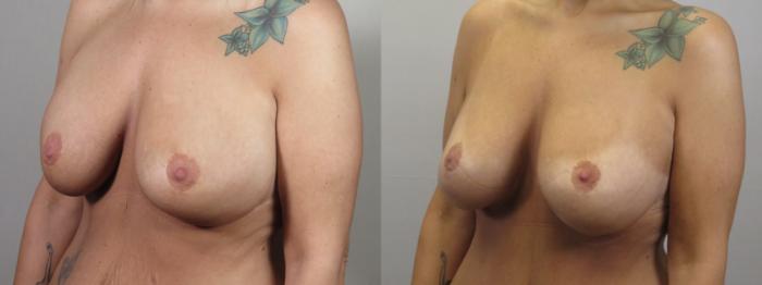 Breast Implant Revision Case 1589 Before & After Left Oblique | Paramus, New Jersey | Parker Center for Plastic Surgery