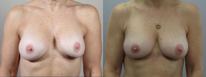 Breast Implant Revision Case 1615 Before & After Front | Paramus, New Jersey | Parker Center for Plastic Surgery