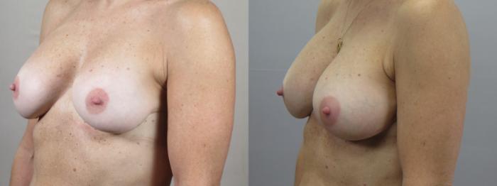 Breast Implant Revision Case 1615 Before & After Left Oblique | Paramus, New Jersey | Parker Center for Plastic Surgery