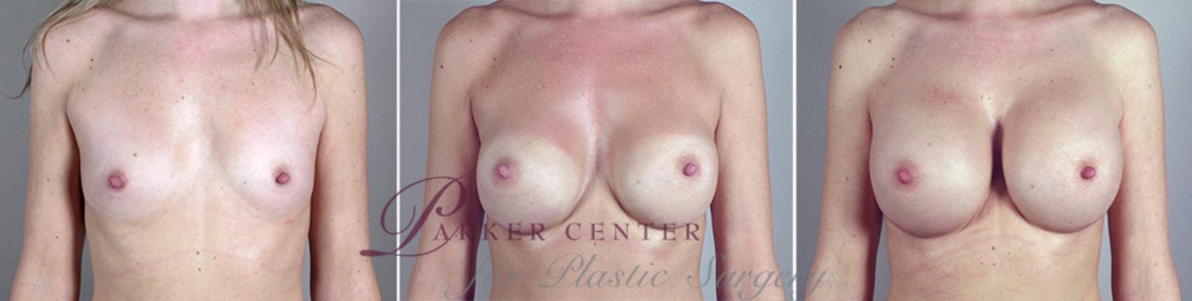 Breast Implant Revision Case 388 Before & After View #1 | Paramus, NJ | Parker Center for Plastic Surgery
