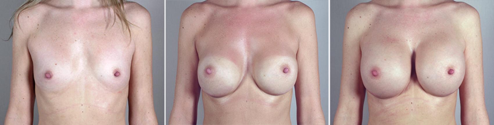 Breast Implant Revision Case 388 Before & After View #1 | Paramus, NJ | Parker Center for Plastic Surgery