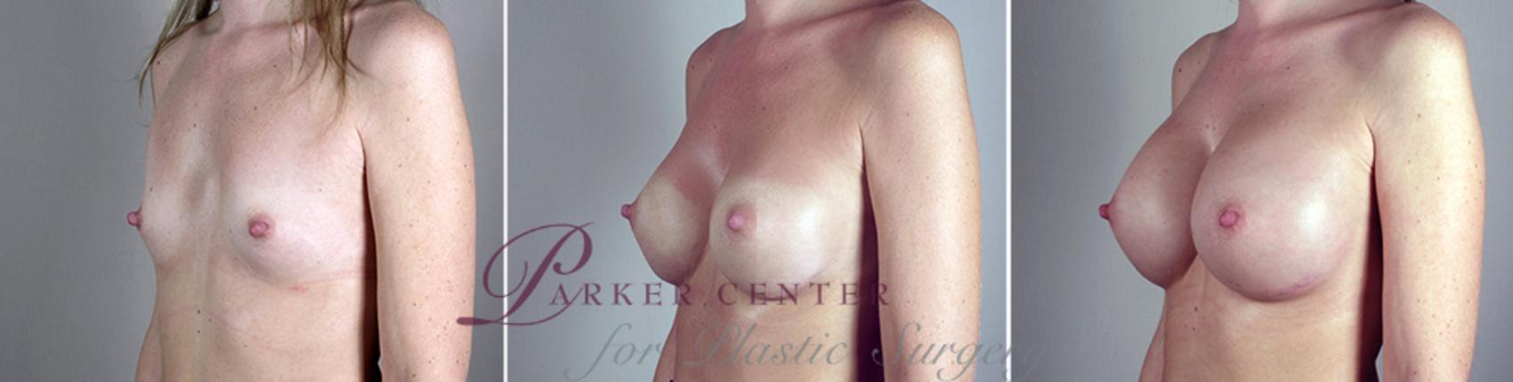 Breast Implant Revision Case 388 Before & After View #2 | Paramus, NJ | Parker Center for Plastic Surgery
