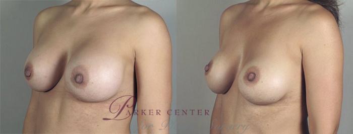 Breast Implant Revision Case 517 Before & After View #2 | Paramus, NJ | Parker Center for Plastic Surgery