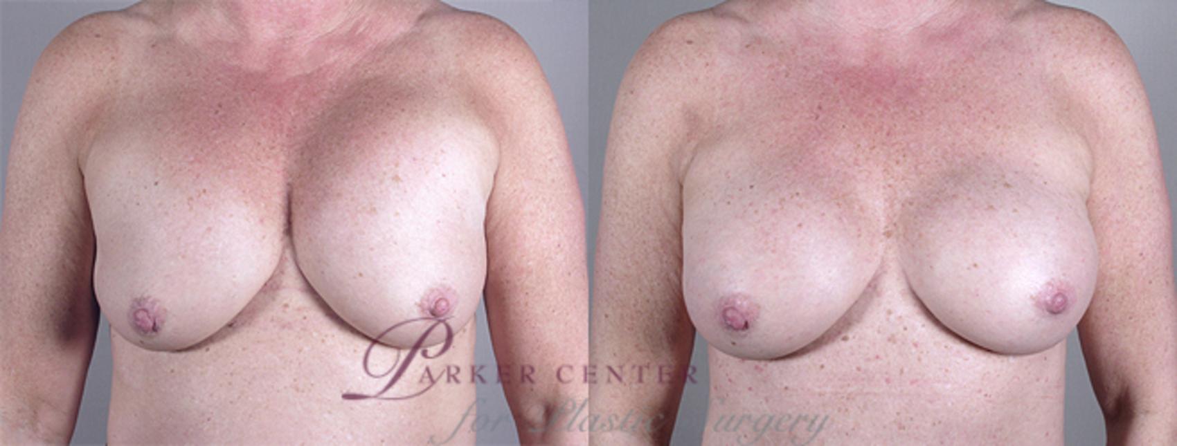 Breast Implant Revision Case 556 Before & After View #1 | Paramus, NJ | Parker Center for Plastic Surgery