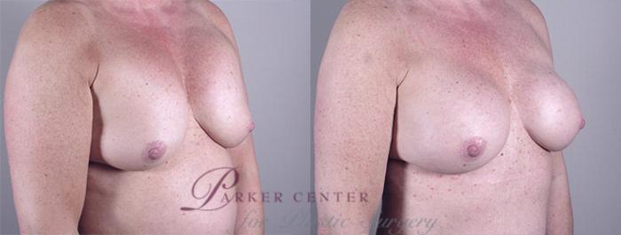 Breast Implant Revision Case 556 Before & After View #2 | Paramus, NJ | Parker Center for Plastic Surgery