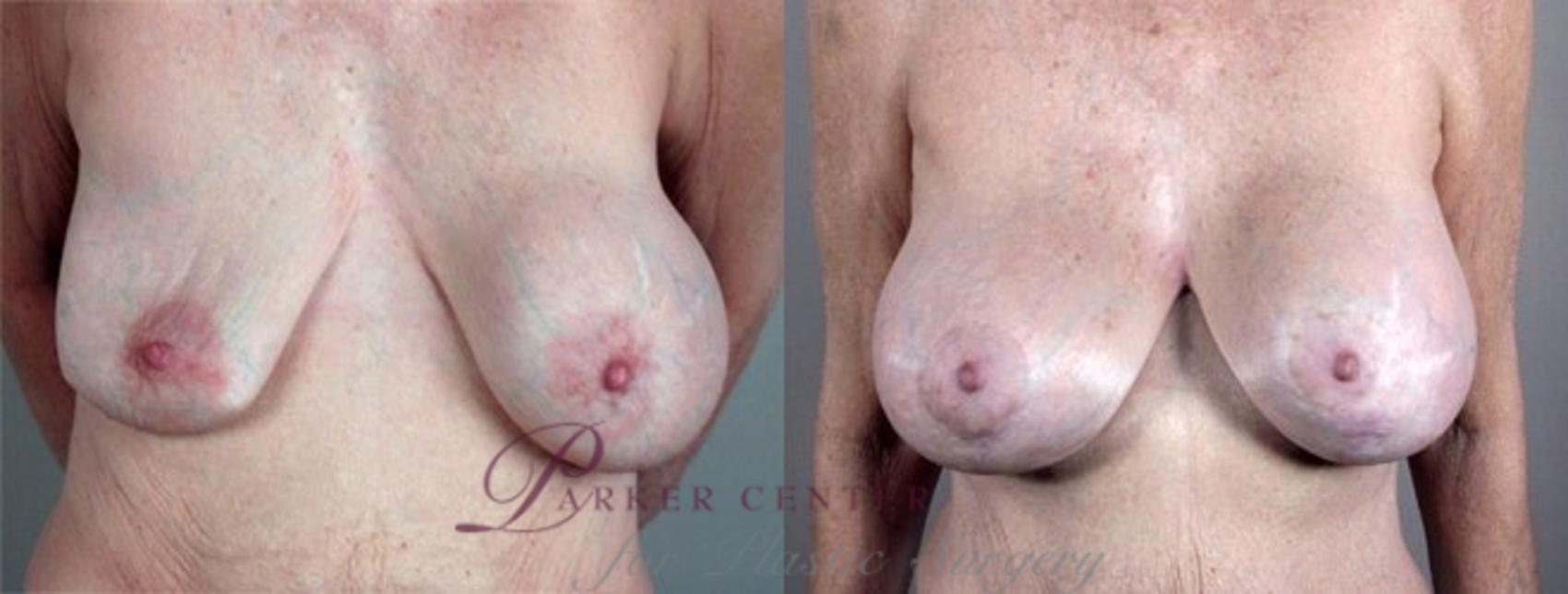 Breast Implant Revision Case 576 Before & After View #1 | Paramus, NJ | Parker Center for Plastic Surgery