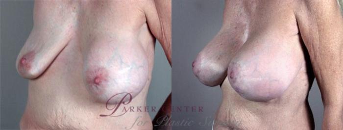 Breast Implant Revision Case 576 Before & After View #2 | Paramus, NJ | Parker Center for Plastic Surgery