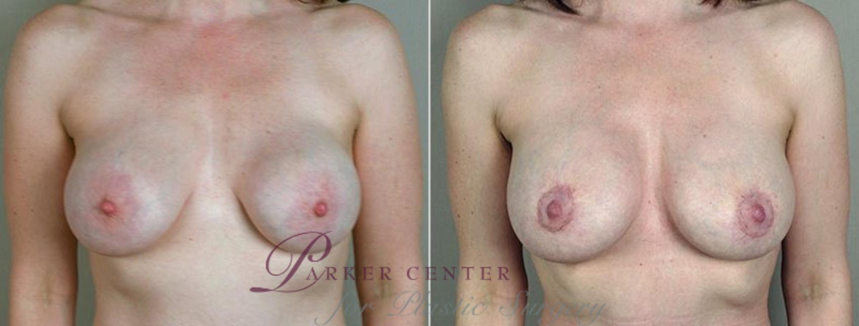 Breast Implant Revision Case 577 Before & After View #1 | Paramus, NJ | Parker Center for Plastic Surgery