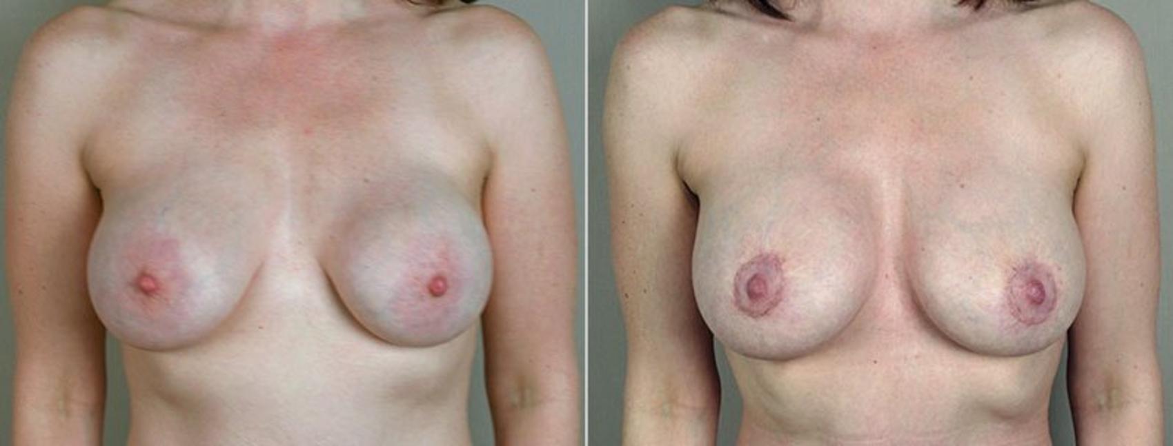 Breast Implant Revision Case 577 Before & After View #1 | Paramus, NJ | Parker Center for Plastic Surgery