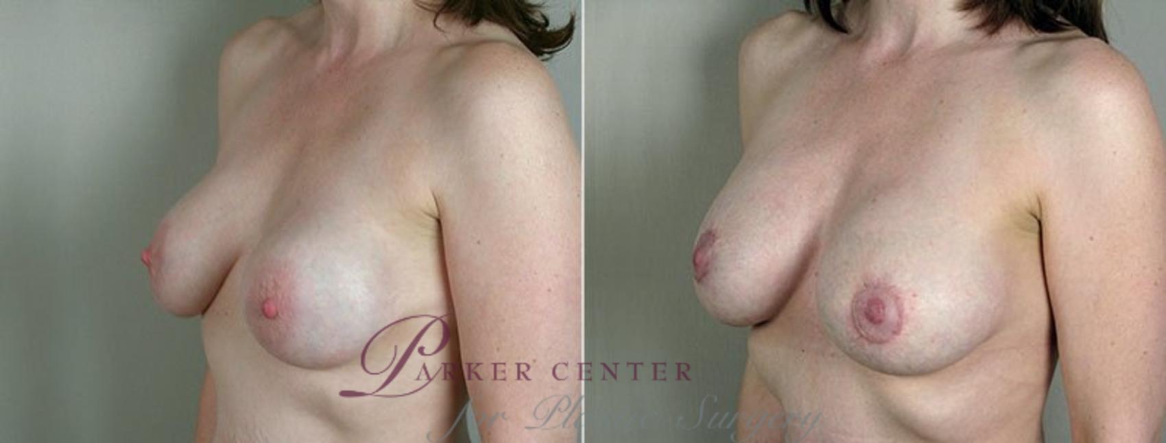 Breast Implant Revision Case 577 Before & After View #2 | Paramus, NJ | Parker Center for Plastic Surgery