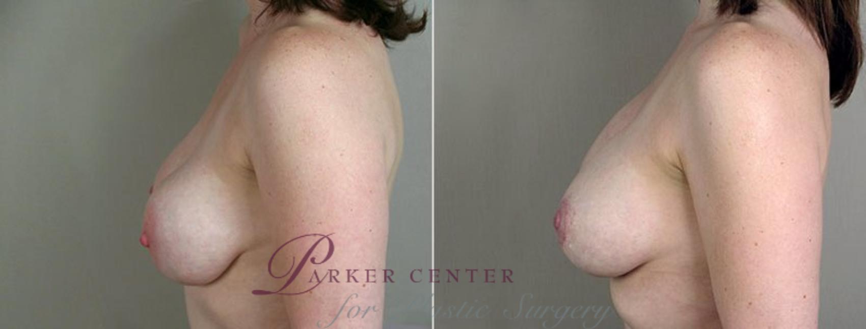 Breast Implant Revision Case 577 Before & After View #3 | Paramus, NJ | Parker Center for Plastic Surgery
