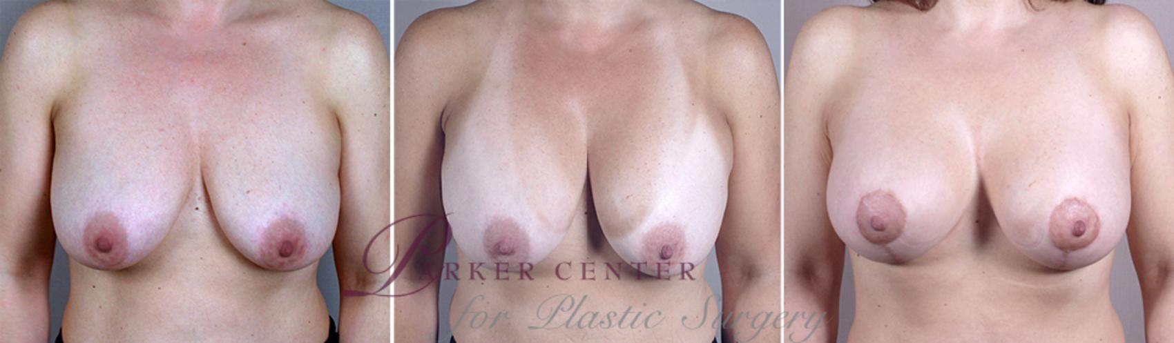 Breast Implant Revision Case 578 Before & After View #1 | Paramus, NJ | Parker Center for Plastic Surgery