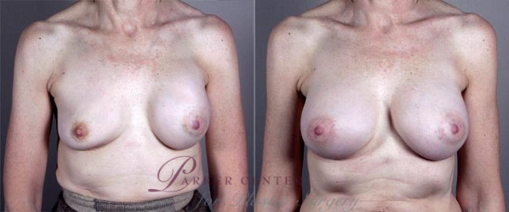 Breast Implant Revision Case 579 Before & After View #1 | Paramus, NJ | Parker Center for Plastic Surgery