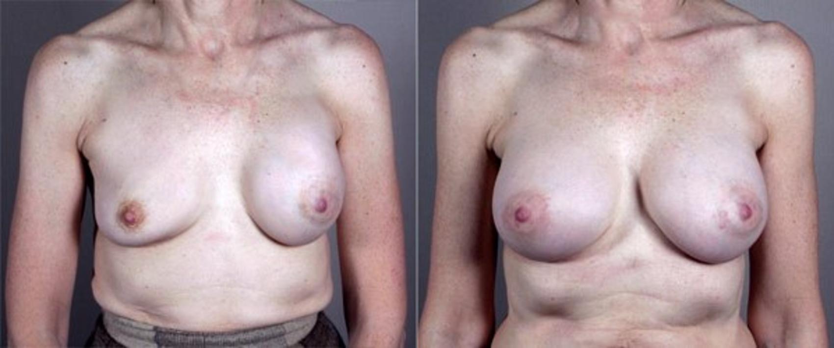 Breast Implant Revision Case 579 Before & After View #1 | Paramus, NJ | Parker Center for Plastic Surgery