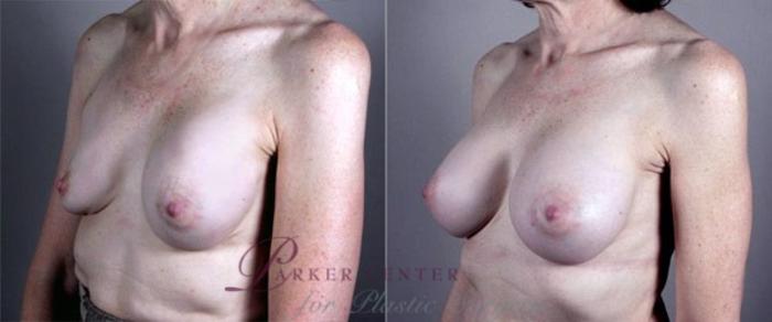 Breast Implant Revision Case 579 Before & After View #2 | Paramus, NJ | Parker Center for Plastic Surgery