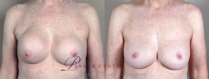 Breast Implant Revision Case 580 Before & After View #1 | Paramus, NJ | Parker Center for Plastic Surgery