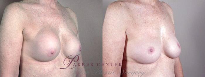 Breast Implant Revision Case 580 Before & After View #2 | Paramus, NJ | Parker Center for Plastic Surgery