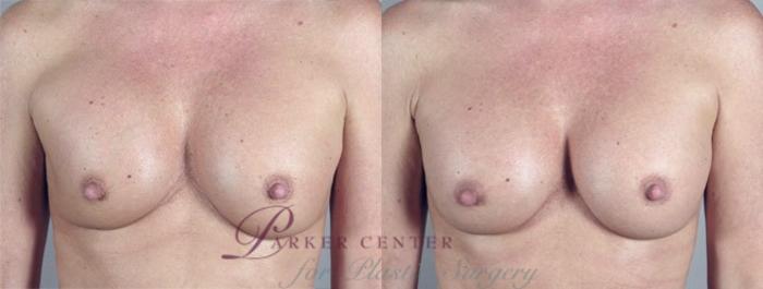 Breast Implant Revision Case 581 Before & After View #1 | Paramus, NJ | Parker Center for Plastic Surgery