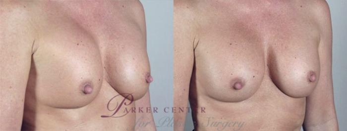 Breast Implant Revision Case 581 Before & After View #2 | Paramus, NJ | Parker Center for Plastic Surgery