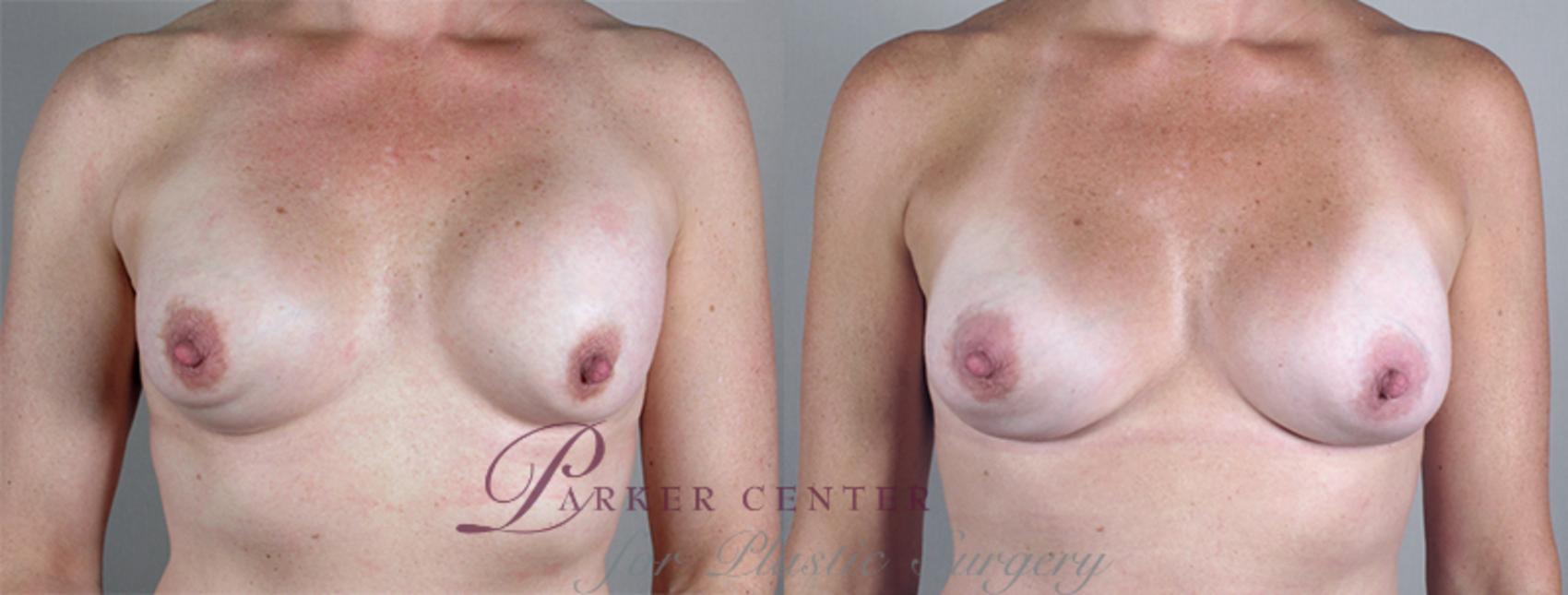 Breast Implant Revision Case 582 Before & After View #1 | Paramus, NJ | Parker Center for Plastic Surgery