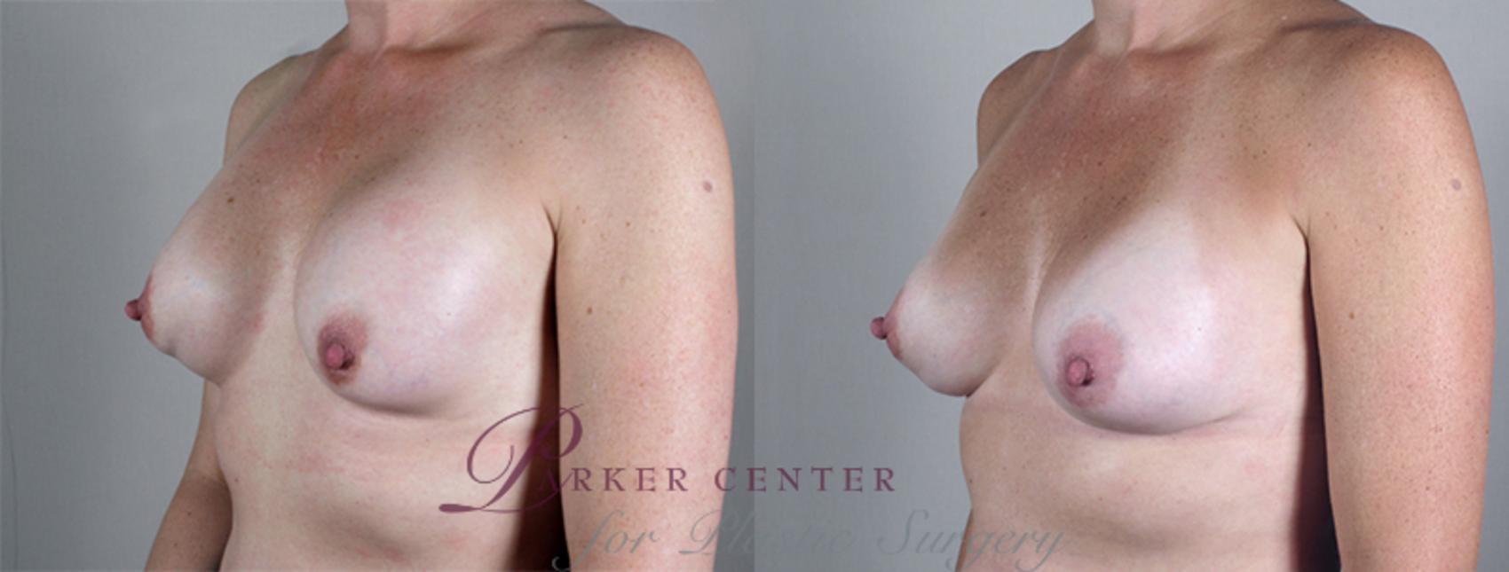 Breast Implant Revision Case 582 Before & After View #2 | Paramus, New Jersey | Parker Center for Plastic Surgery