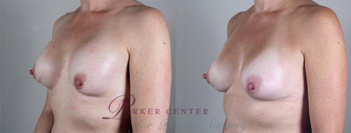 Breast Implant Revision Case 582 Before & After View #2 | Paramus, NJ | Parker Center for Plastic Surgery