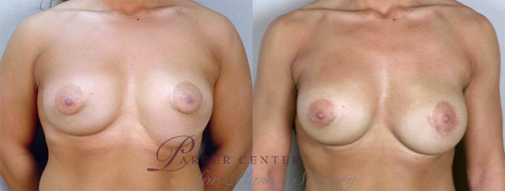 Breast Implant Revision Case 583 Before & After View #1 | Paramus, NJ | Parker Center for Plastic Surgery