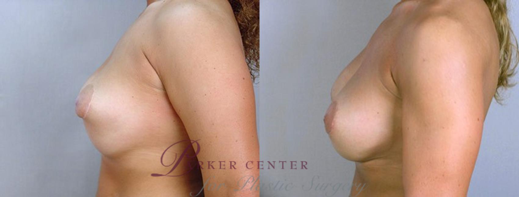 Breast Implant Revision Case 583 Before & After View #2 | Paramus, New Jersey | Parker Center for Plastic Surgery