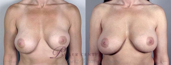 Breast Implant Revision Case 584 Before & After View #1 | Paramus, NJ | Parker Center for Plastic Surgery