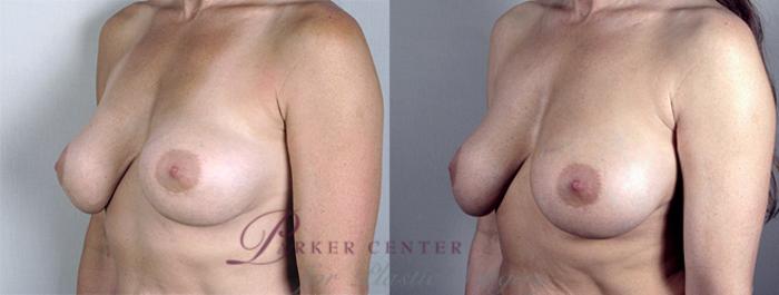 Breast Implant Revision Case 584 Before & After View #2 | Paramus, NJ | Parker Center for Plastic Surgery