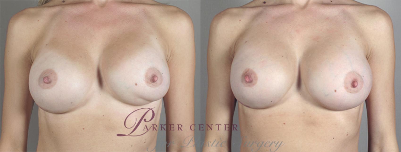 Breast Implant Revision Case 585 Before & After View #1 | Paramus, NJ | Parker Center for Plastic Surgery